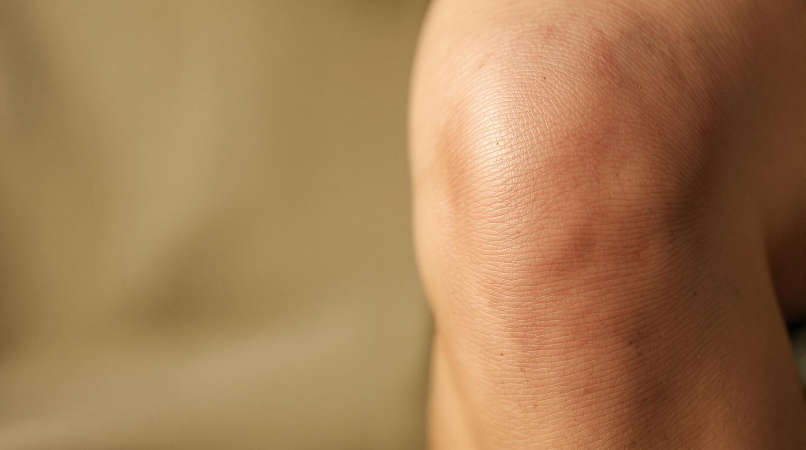 Tout savoir sur les vergetures au genou